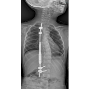 scoliosi-mini-post-neonato-vommaro